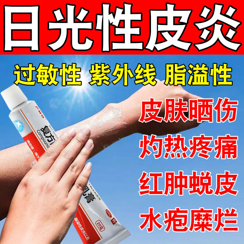 紫外线过敏擦什么药