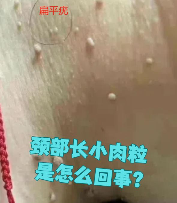 脖子上长小肉刺是什么原因?