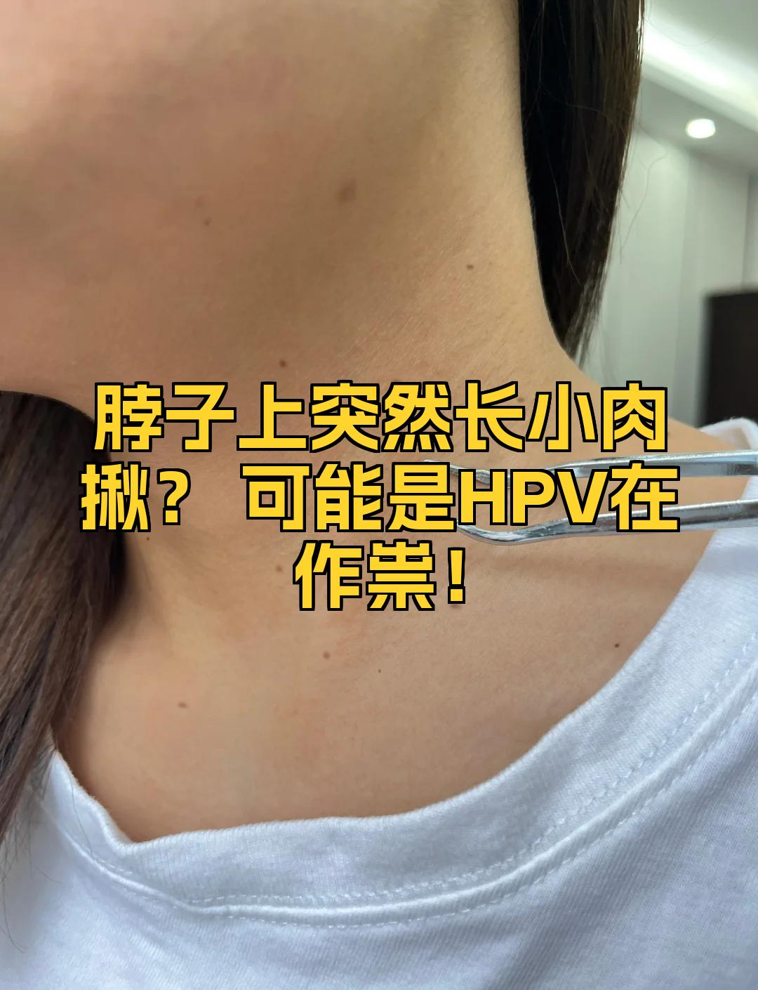 脖子上长小肉刺是什么原因?