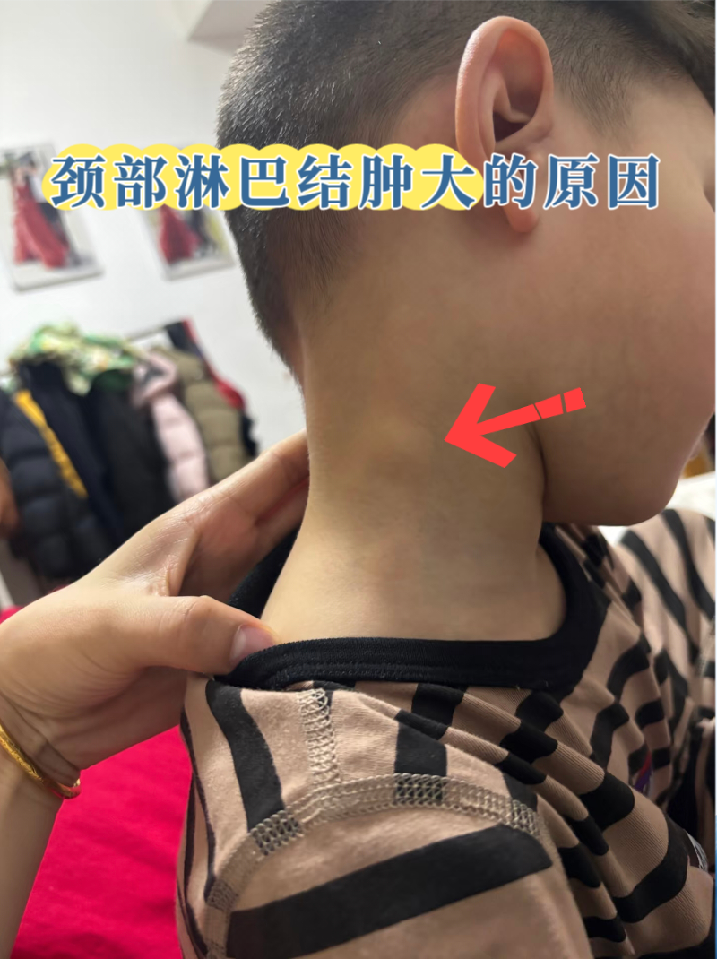 颈部淋巴结长期肿大,危险吗