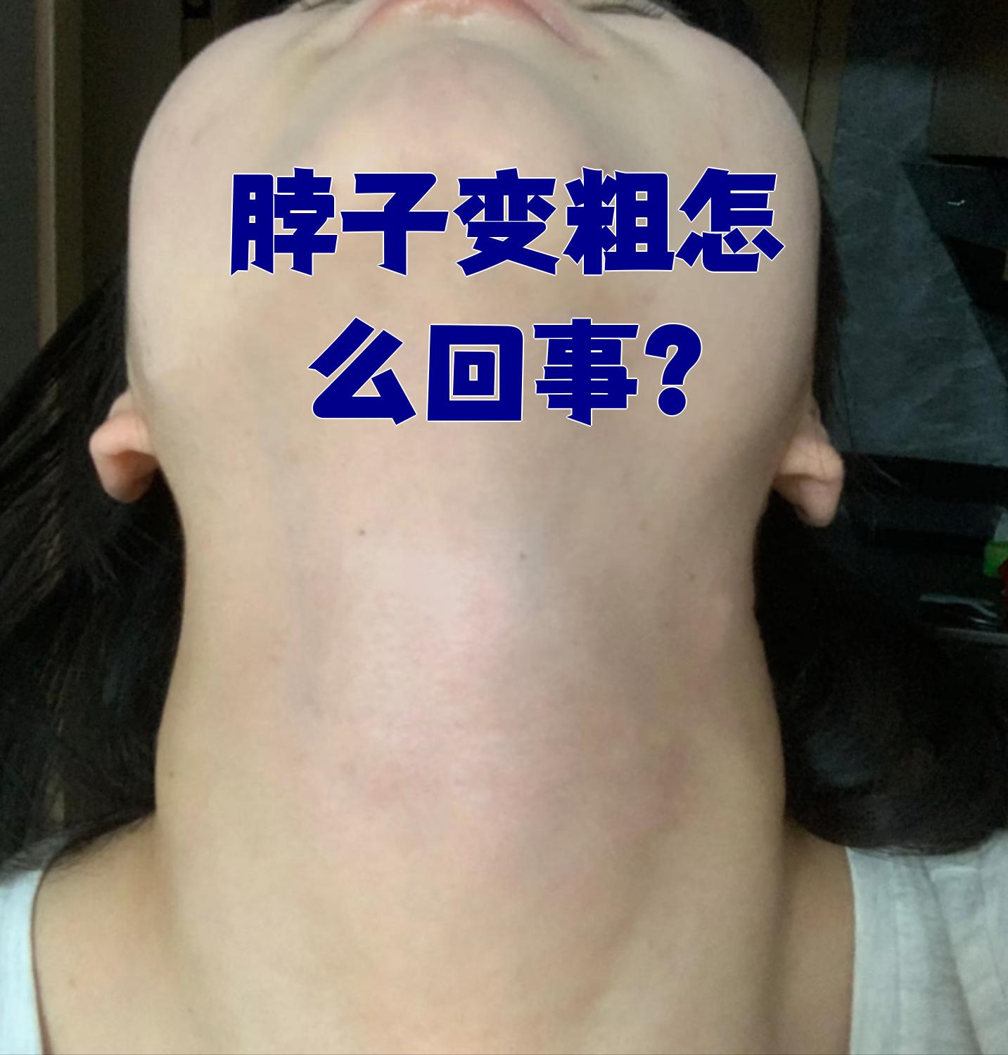 甲状腺肿大有哪些症状?