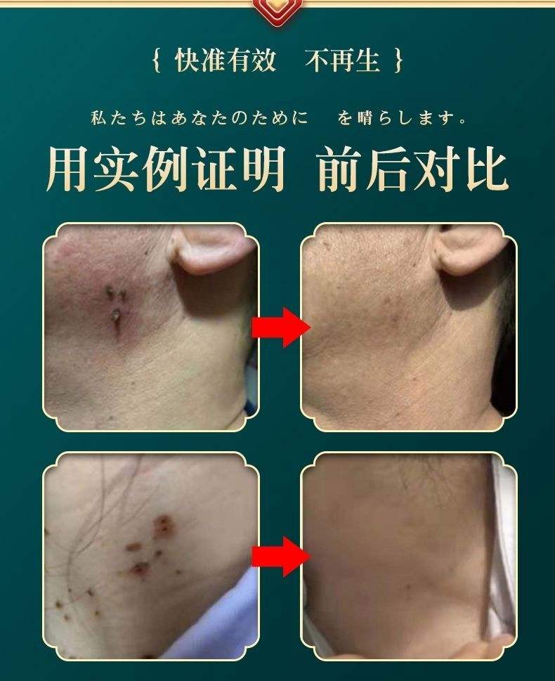 用激光去除身上的肉猴要多少钱