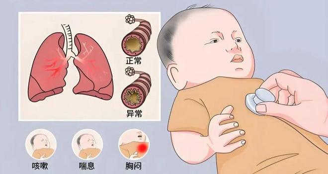 小儿急性支气管炎