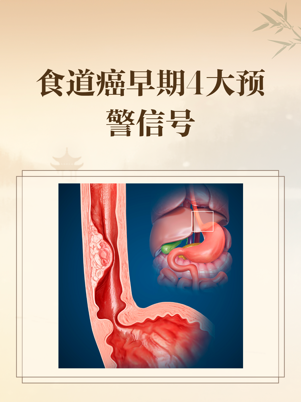 食管癌的早期症状表现有哪些呢