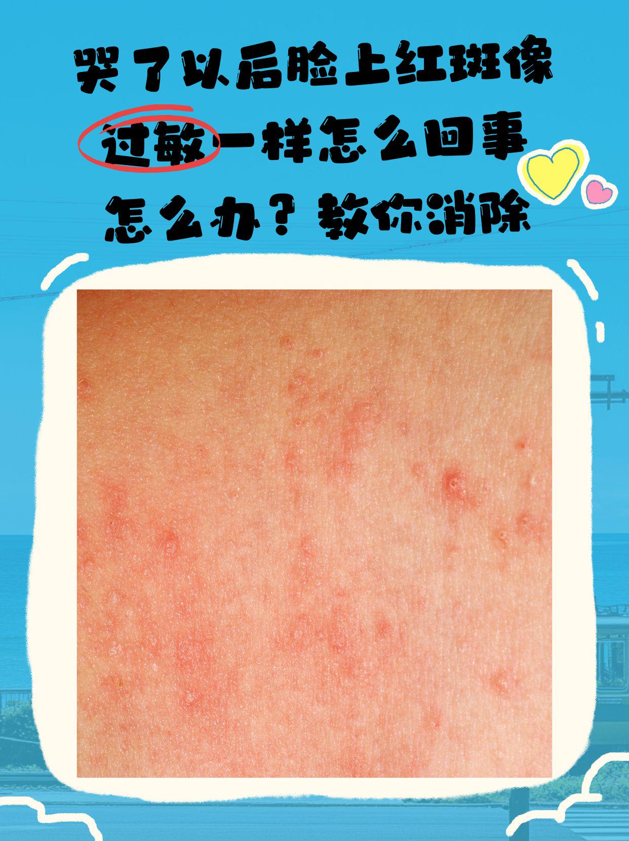 脸上出现红疹的原因及解决方法