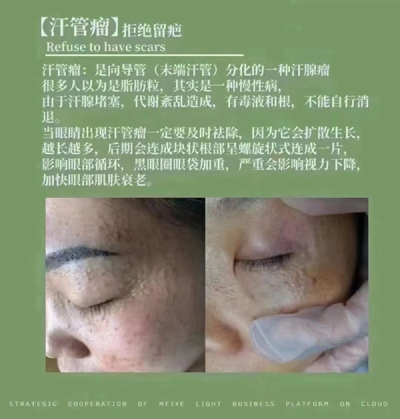 治疗汗管瘤方法有哪些?
