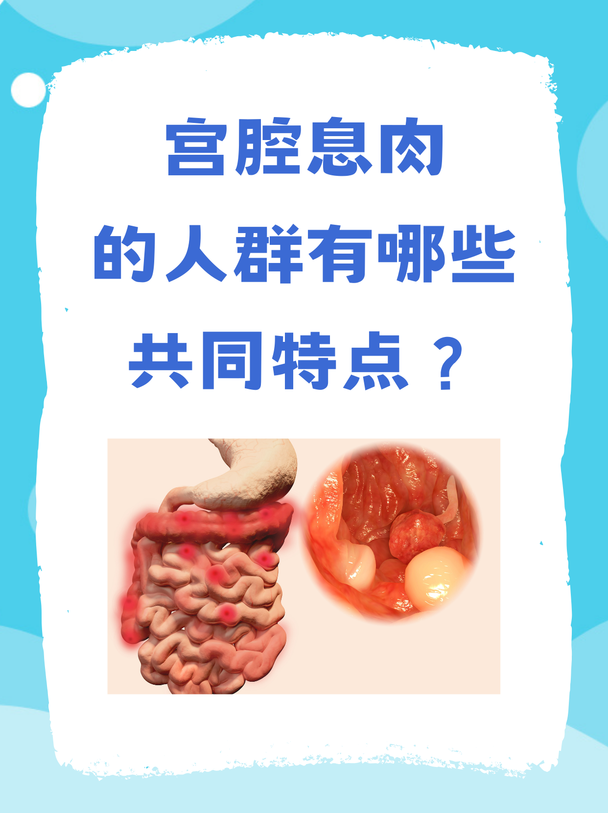 什么是子宫颈息肉