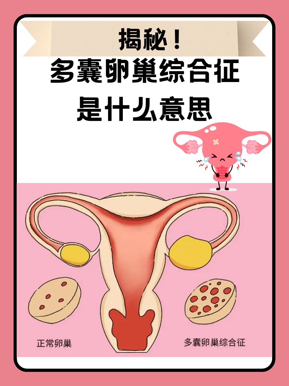 多囊卵巢怎么检查出来?