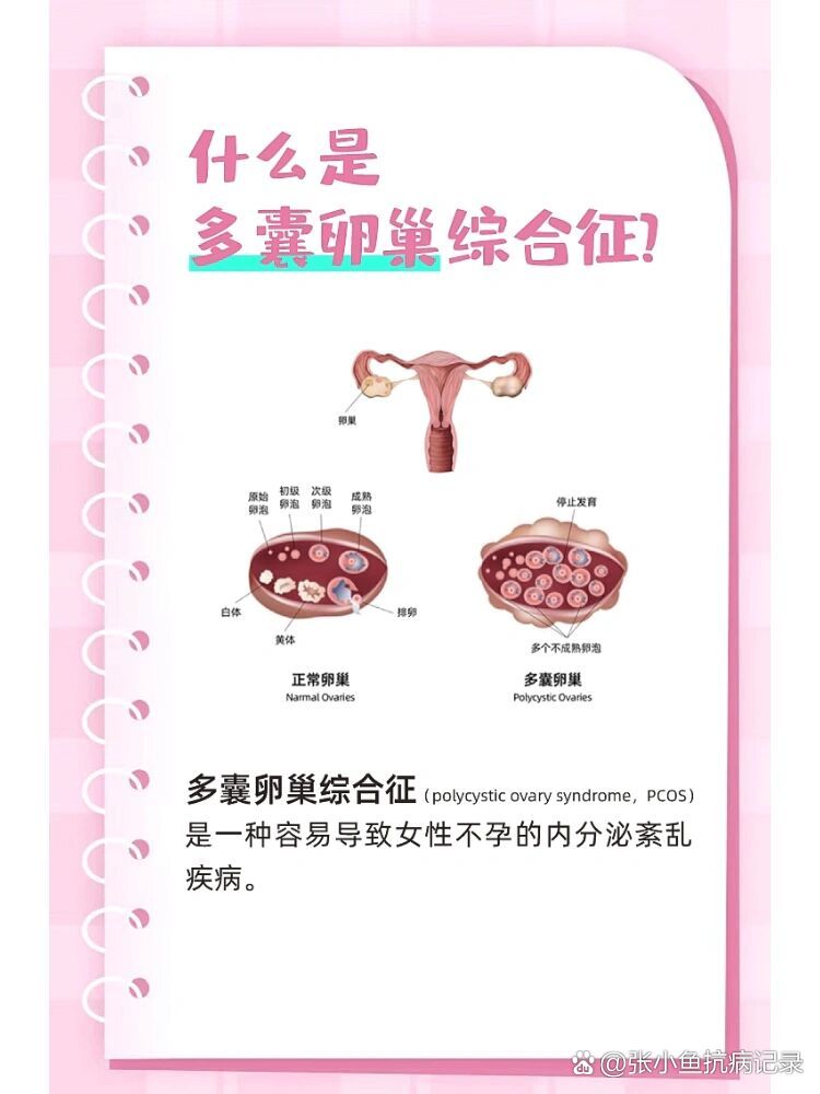 多囊卵巢怎么检查出来?