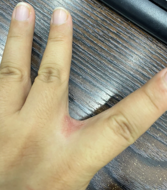 手指突然红肿疼怎么回事