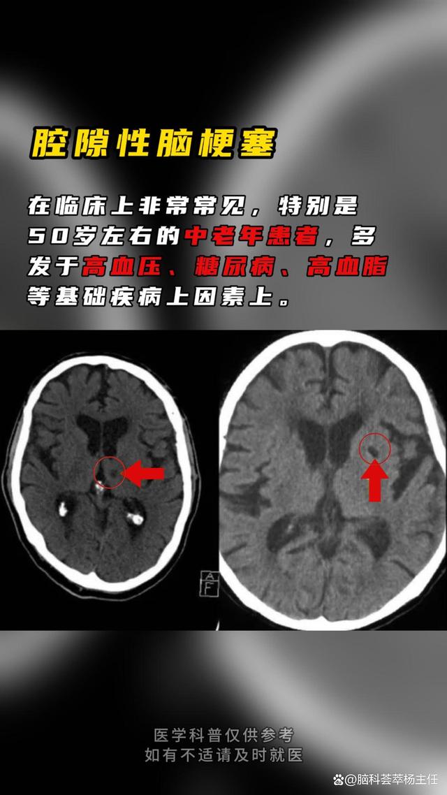 腔隙性脑梗塞严重吗?