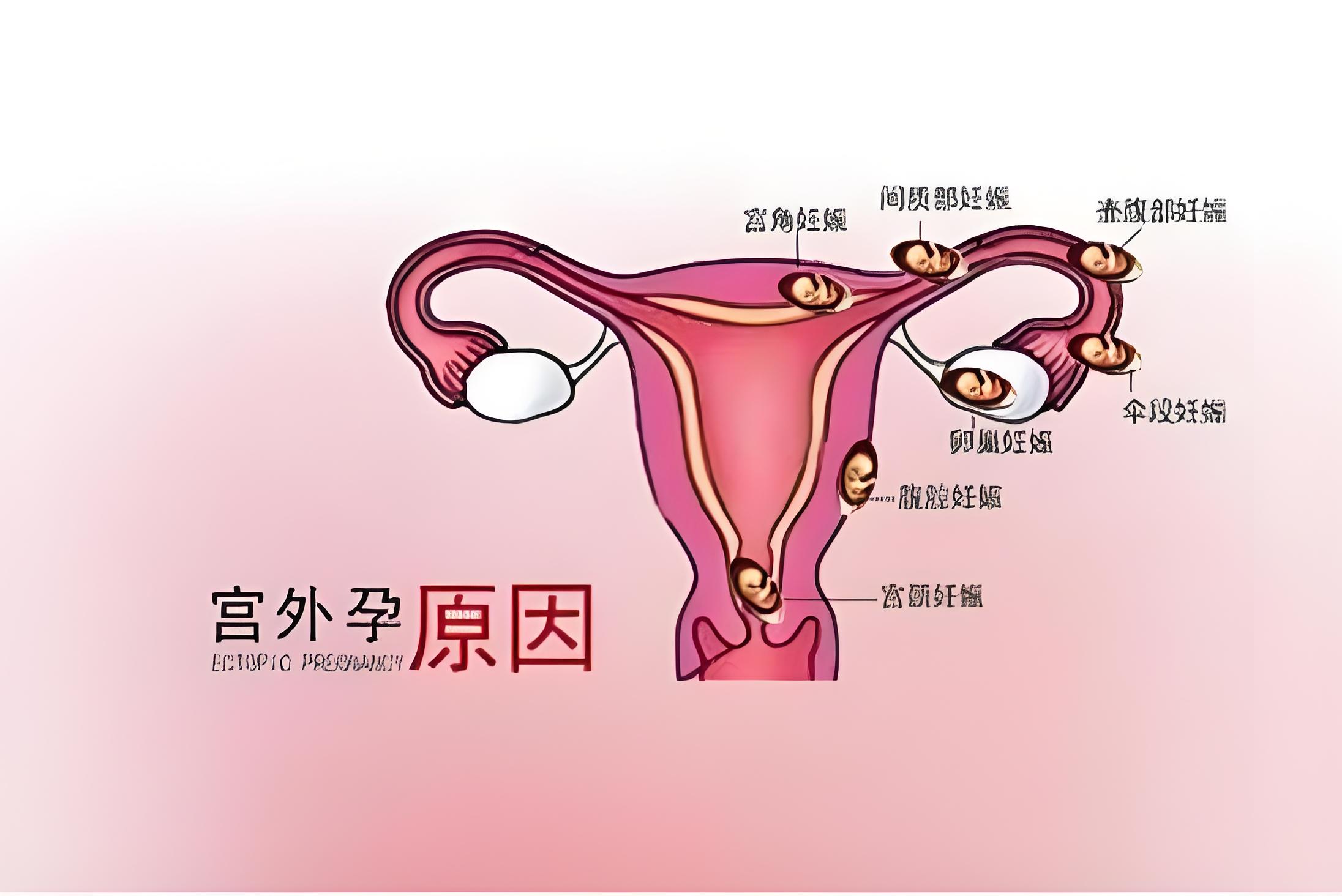 宫外孕的早期有哪些症状