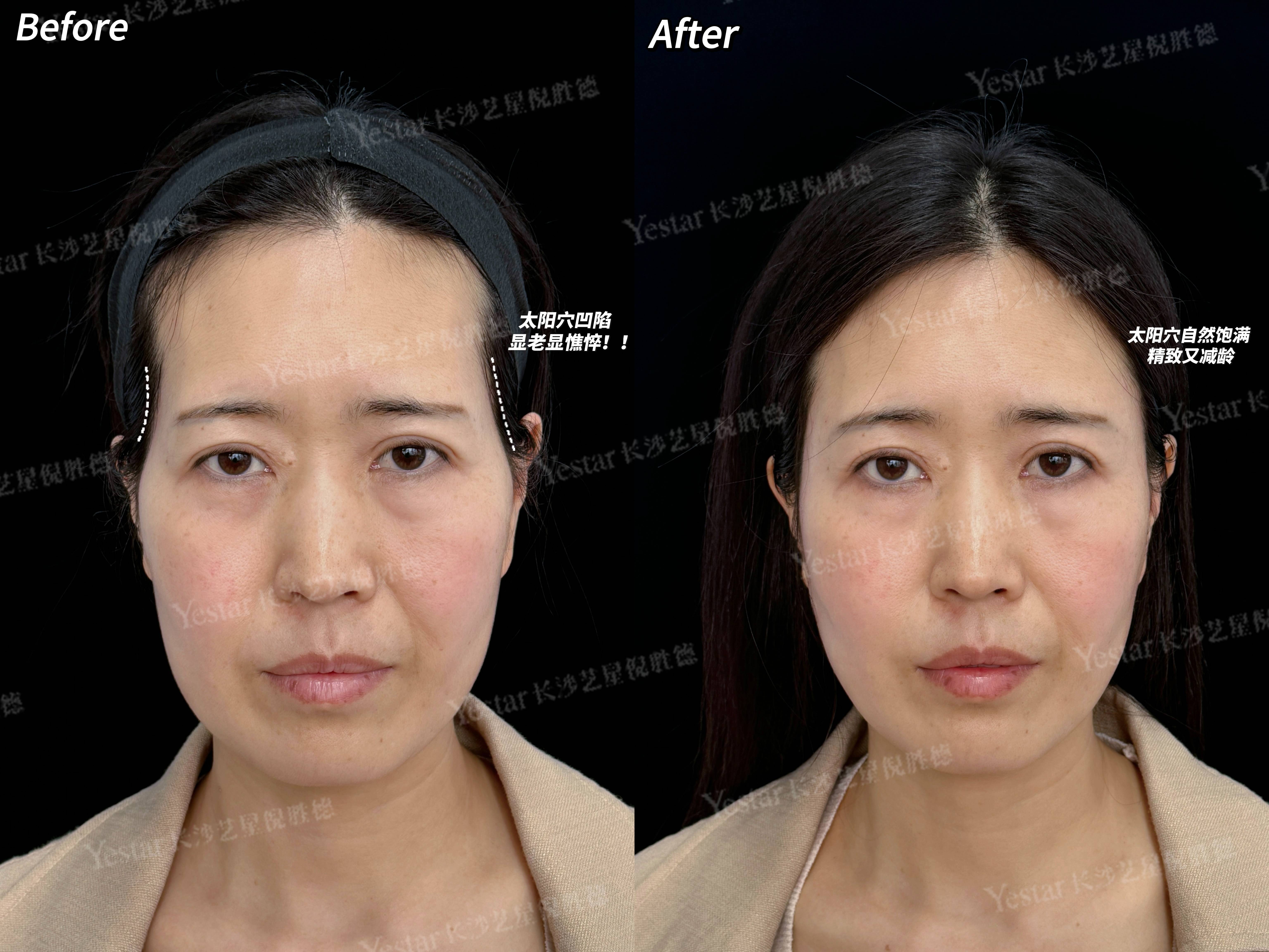 玻尿酸丰太阳穴好处有哪些?