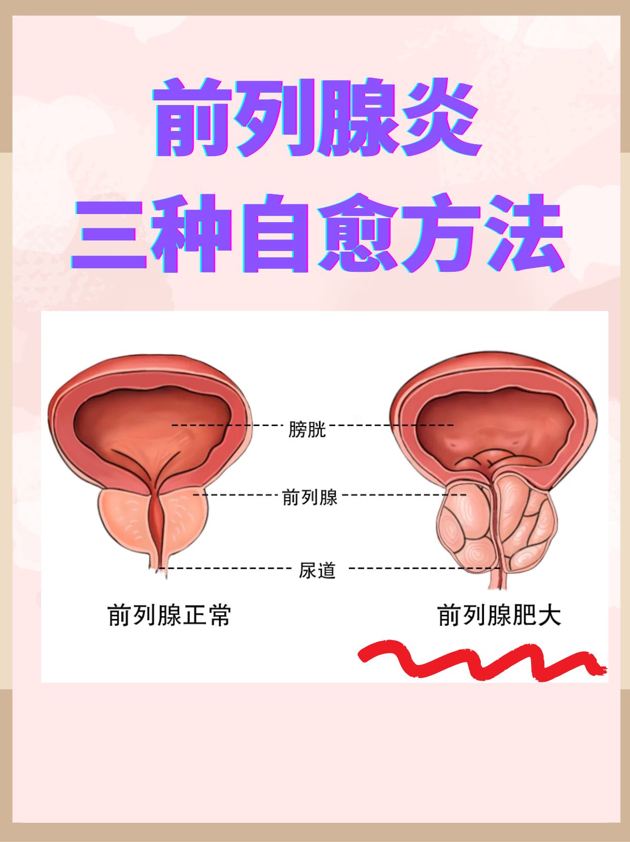 得了前列腺炎一般有哪些症状