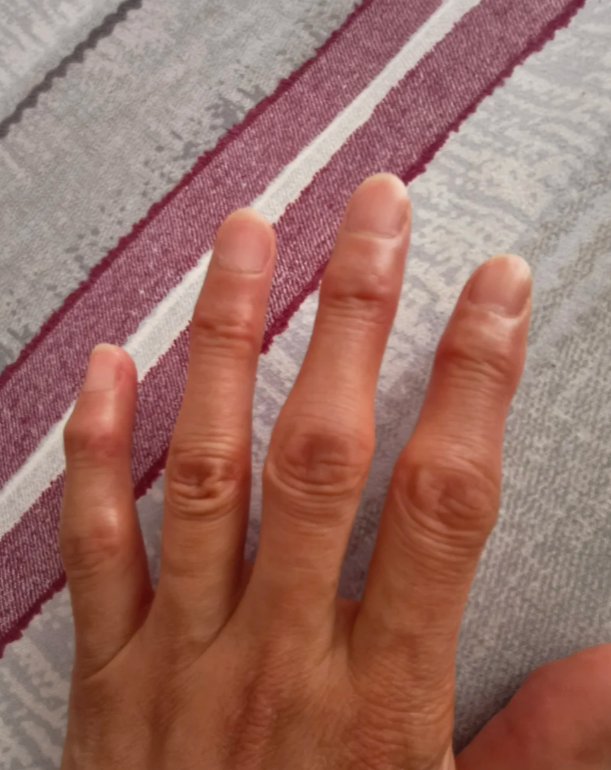 骨性关节炎的症状表现