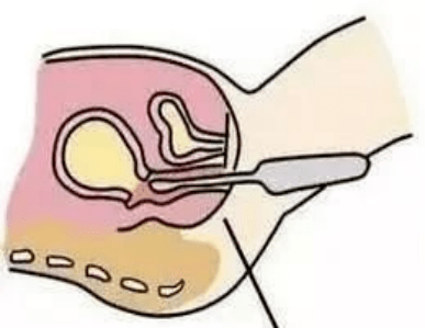 做完阴道超应注意什么