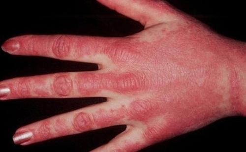 皮肌炎有哪些症状?