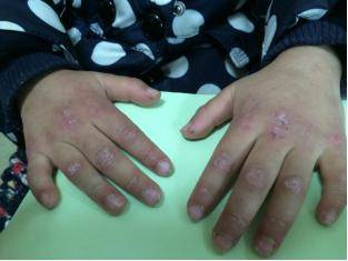 皮肌炎有哪些症状?