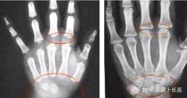 比尔高真的能够长高吗?会不会反弹?