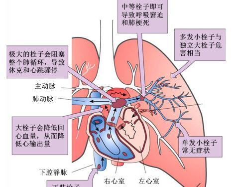 右心衰竭症状