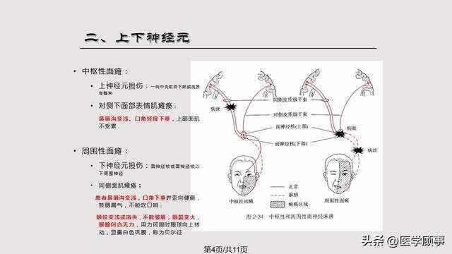 面神经炎与面瘫有什么区别