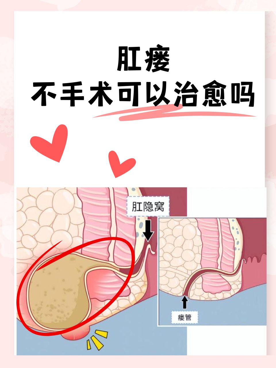 肛瘘怎么治疗的