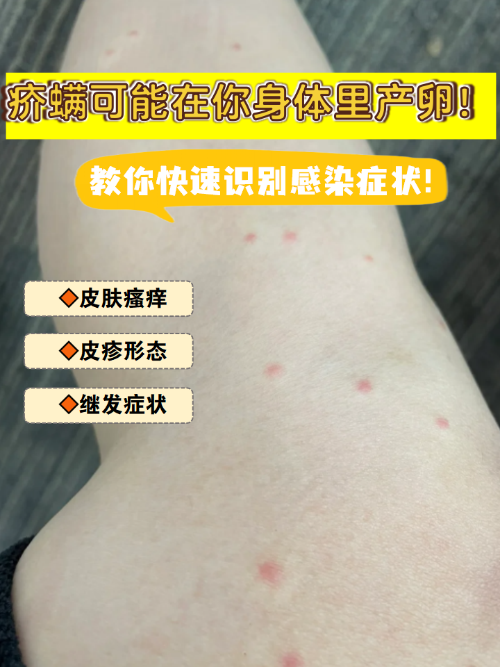 疥疮如何传播?
