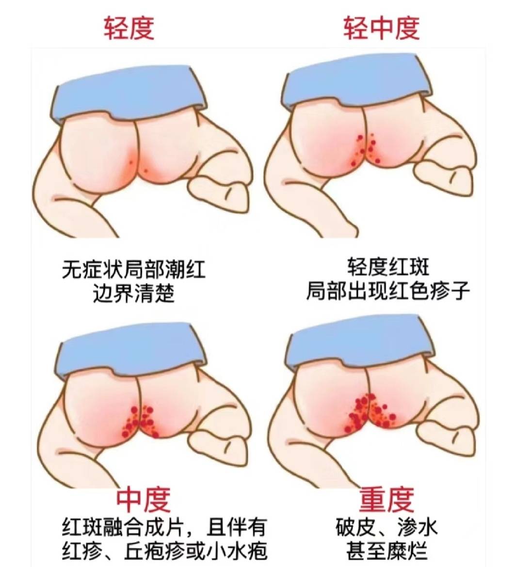 外阴溃疡涂什么药最好