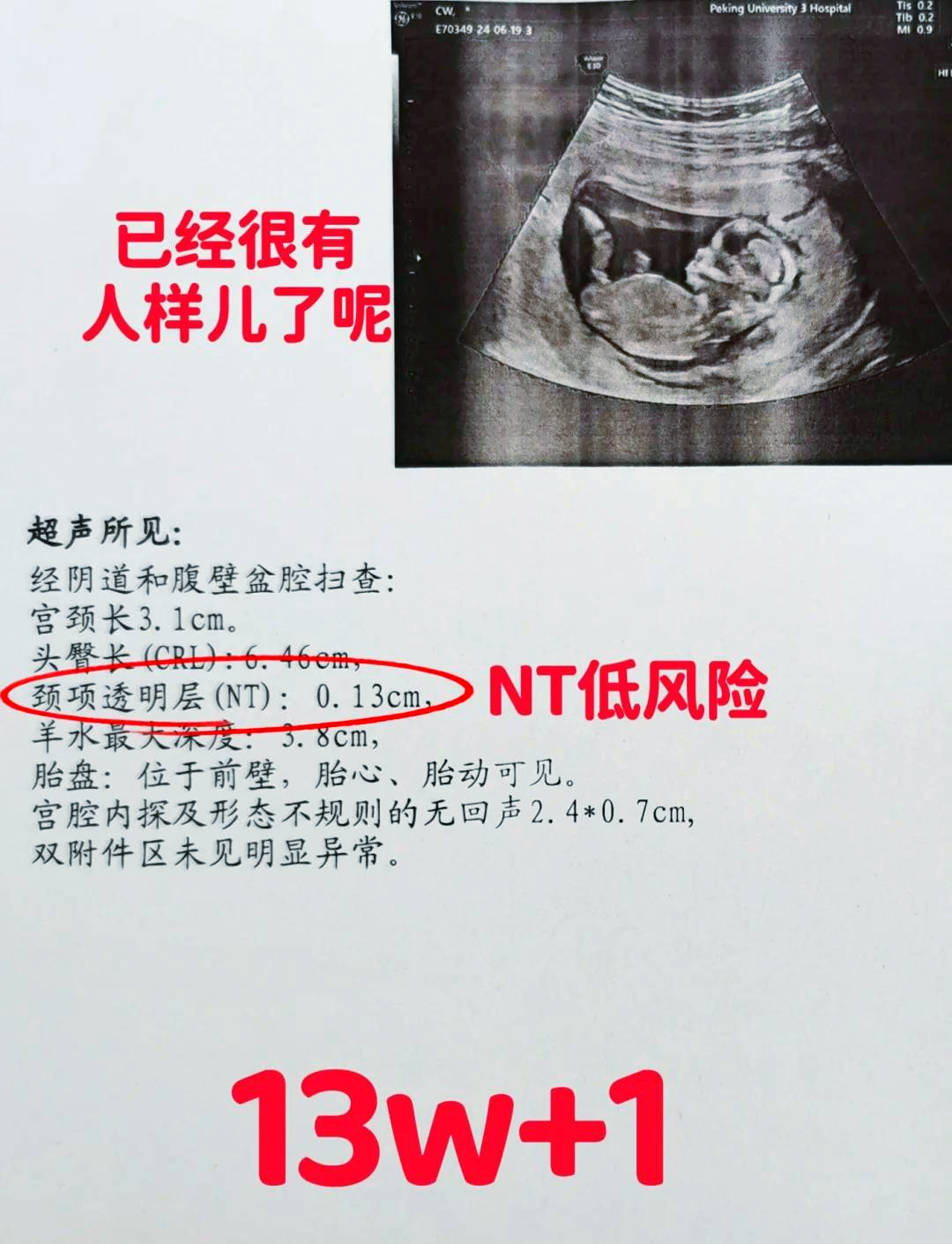 NTB超有必要做吗???