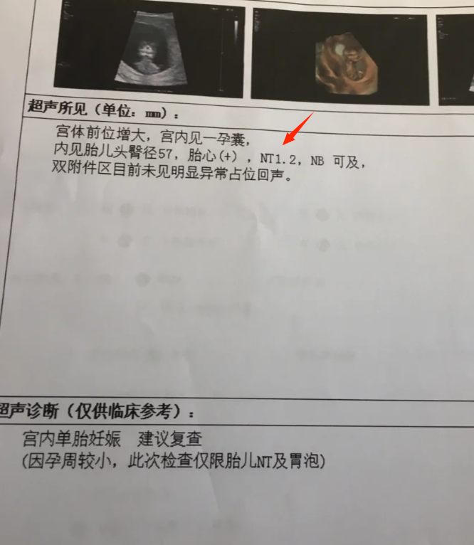 NTB超有必要做吗???