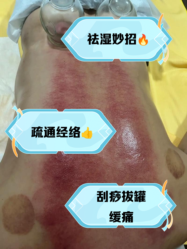 刮痧拔罐后能同房吗