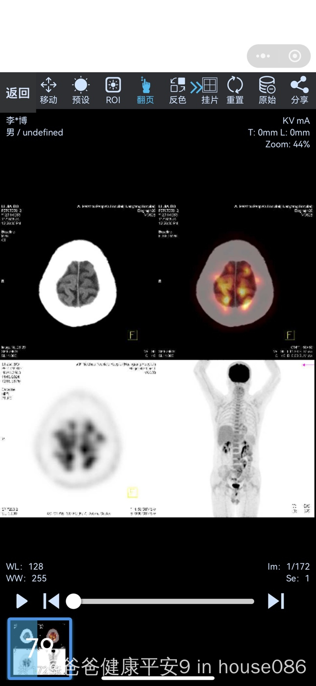 petct能确诊癌症吗