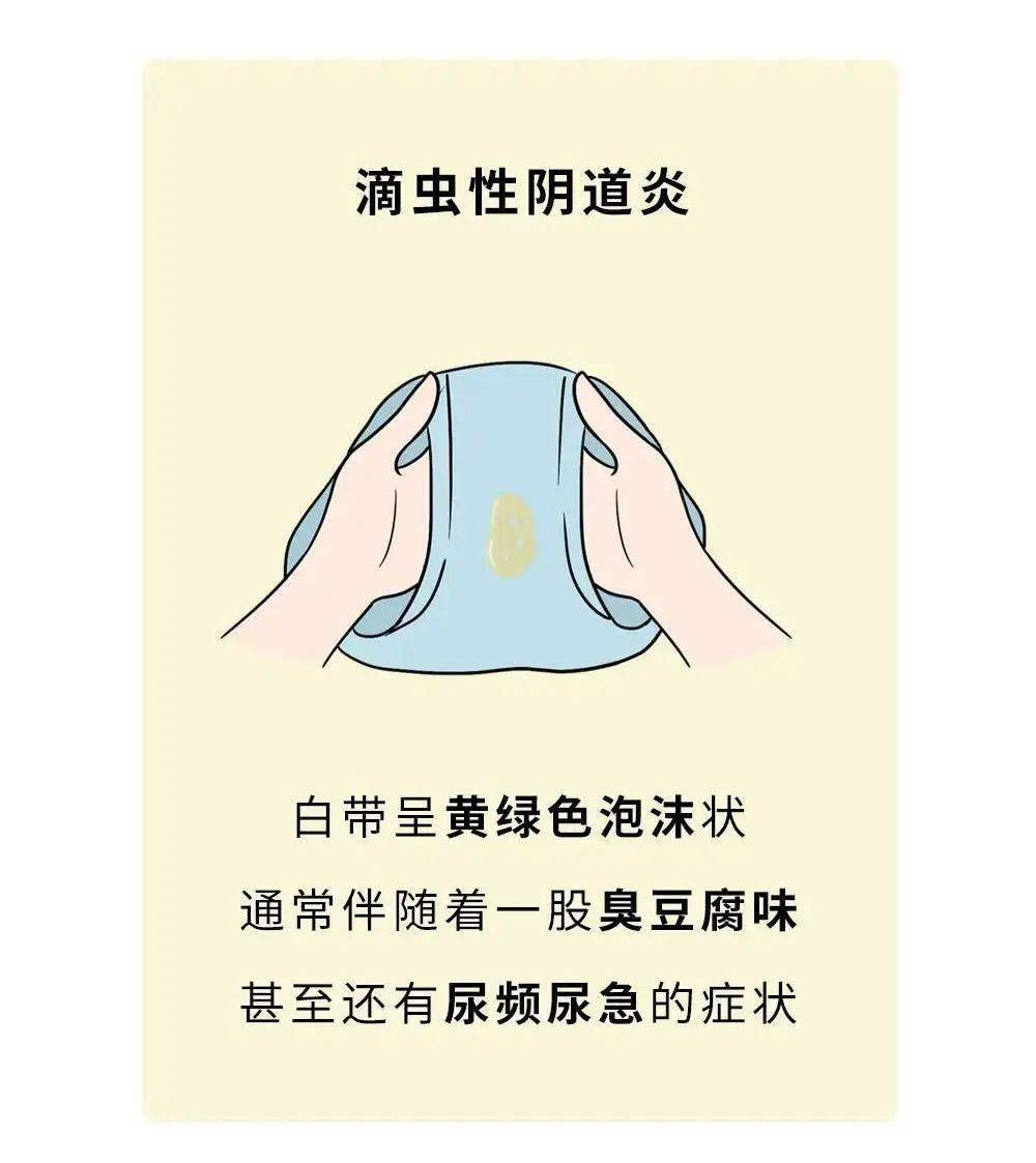 怎么治滴虫性阴道炎病