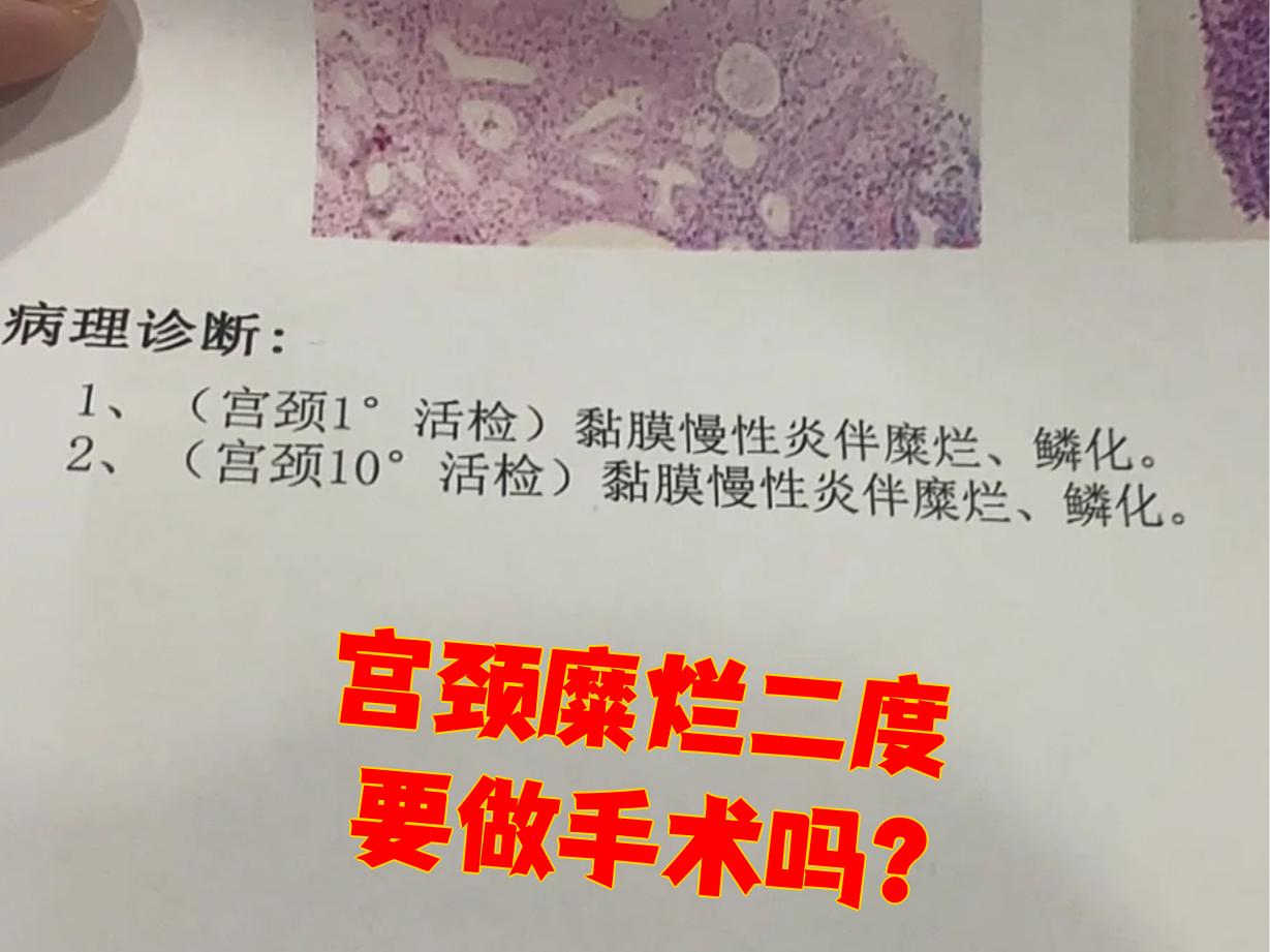 请问宫颈糜烂二度严重吗