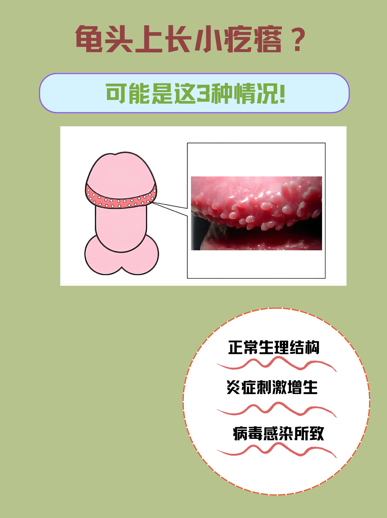 冠状沟珍珠疹,是什么?