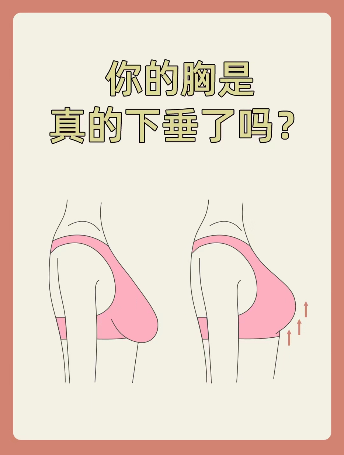 如何矫正乳房下垂