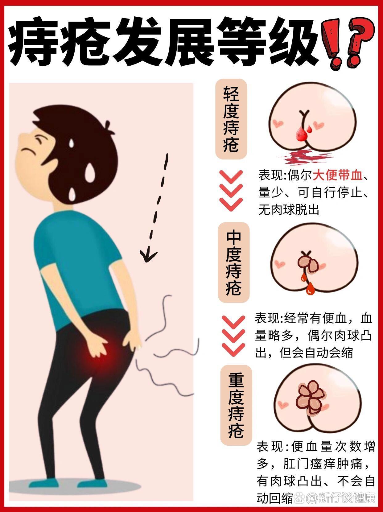 痔疮长在什么部位