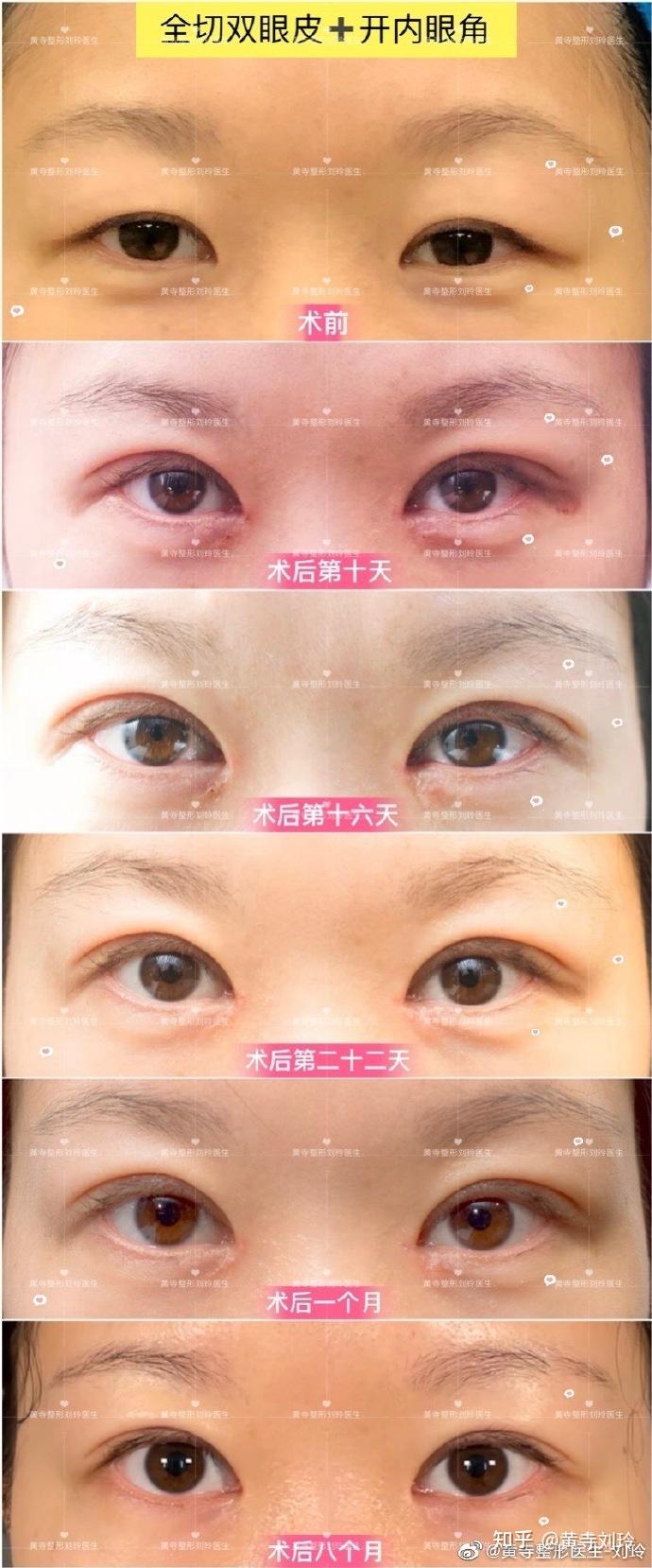 割双眼皮什么年龄合适?