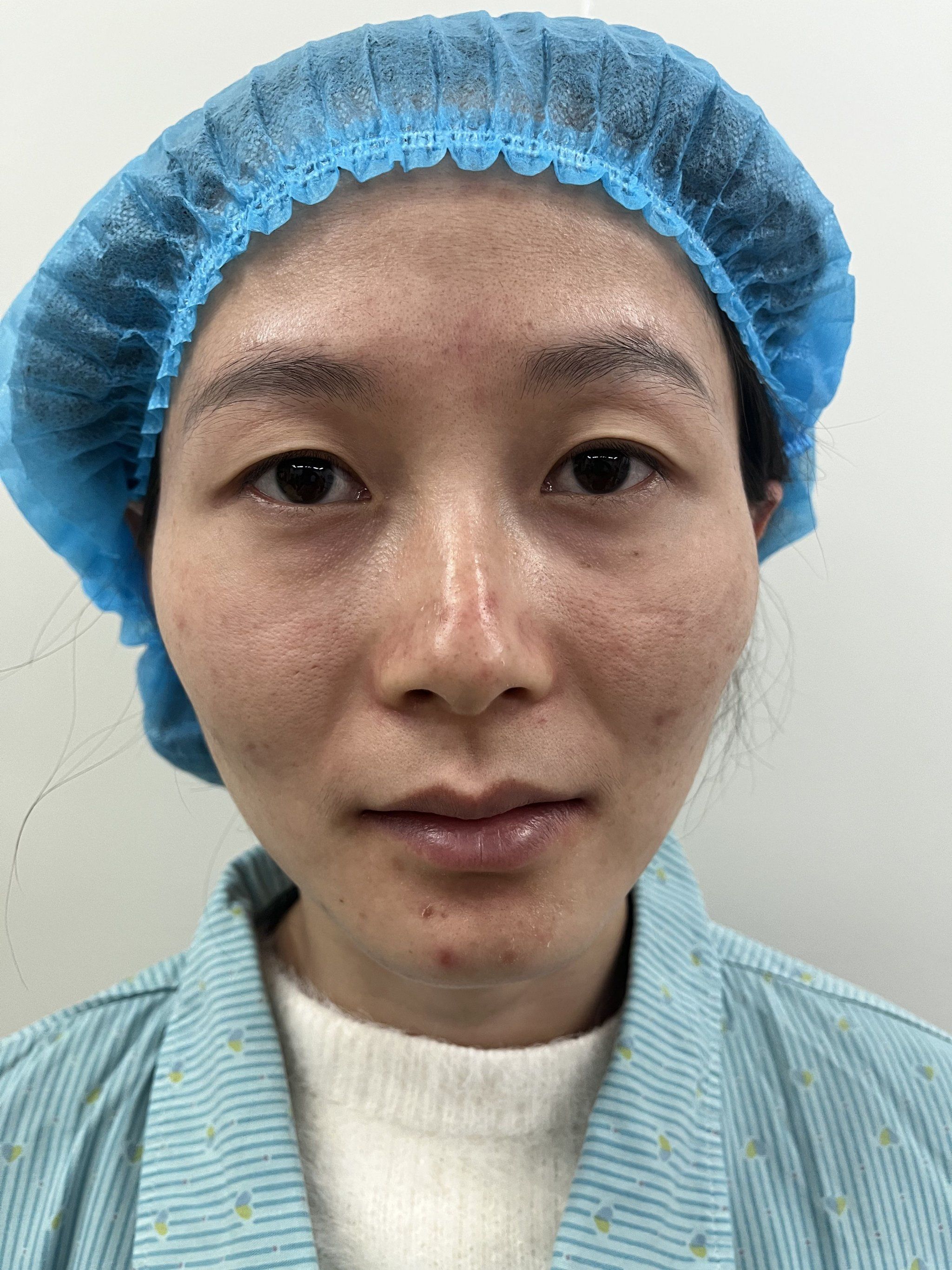 割双眼皮什么年龄合适?