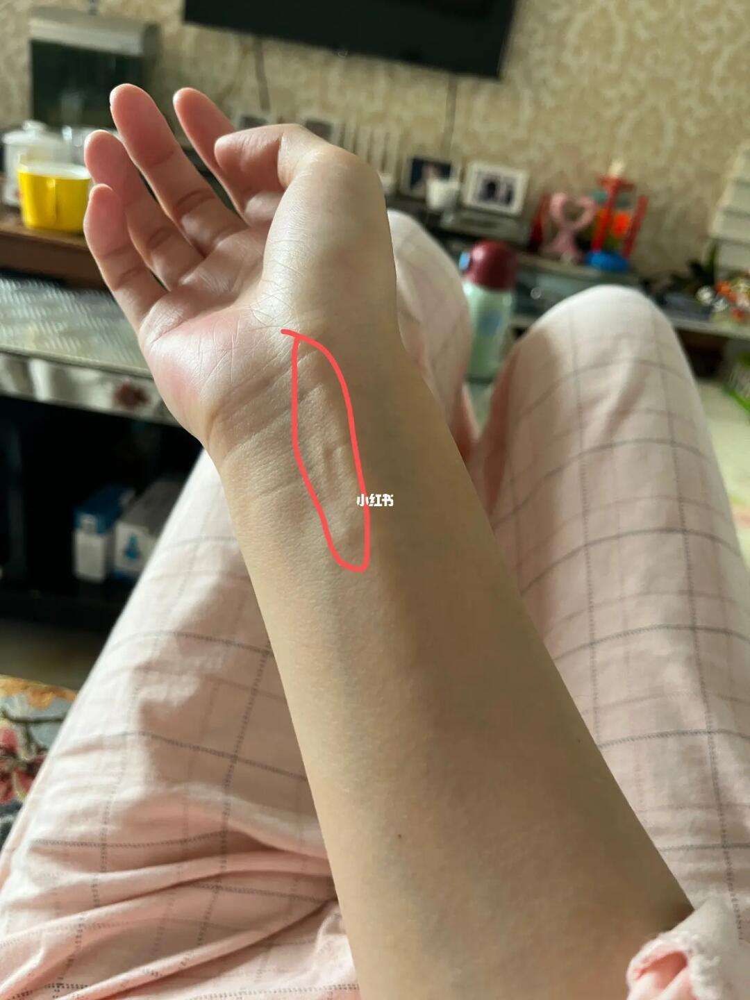 手腕扭到筋了,不能动,一动就疼