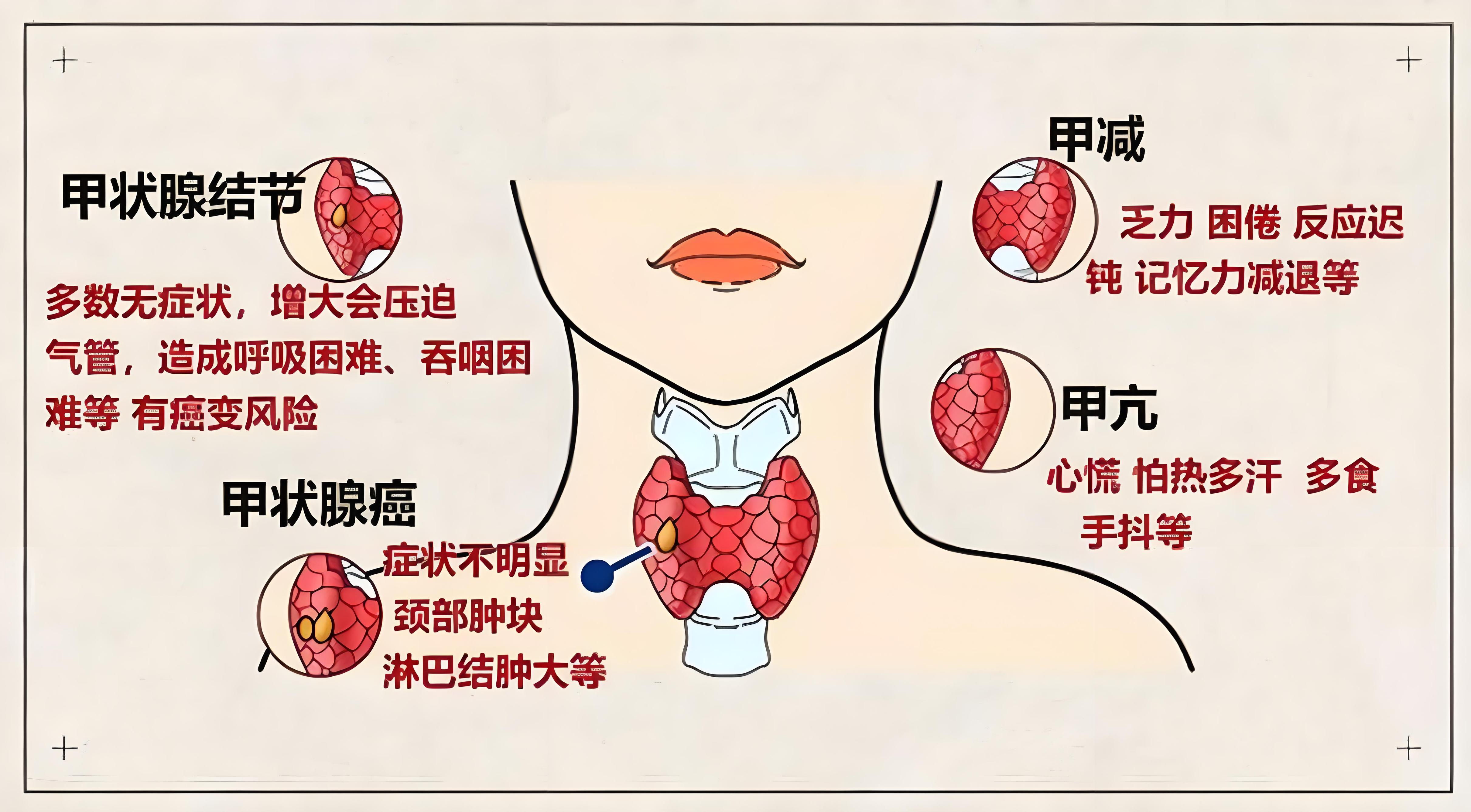 甲状腺结节的发病原因