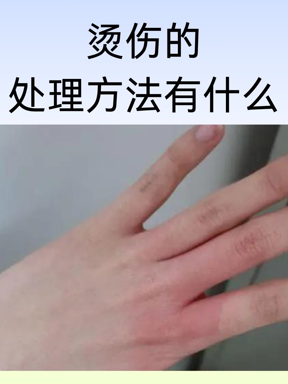 烫伤后怎么处理不留疤痕