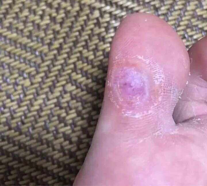 鸡眼怎么样才算好清了