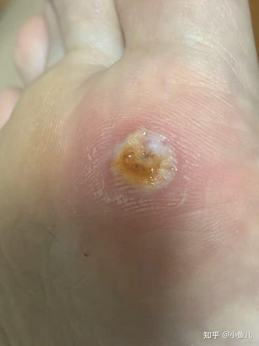 鸡眼怎么样才算好清了