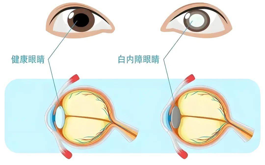 轻微白内障症状