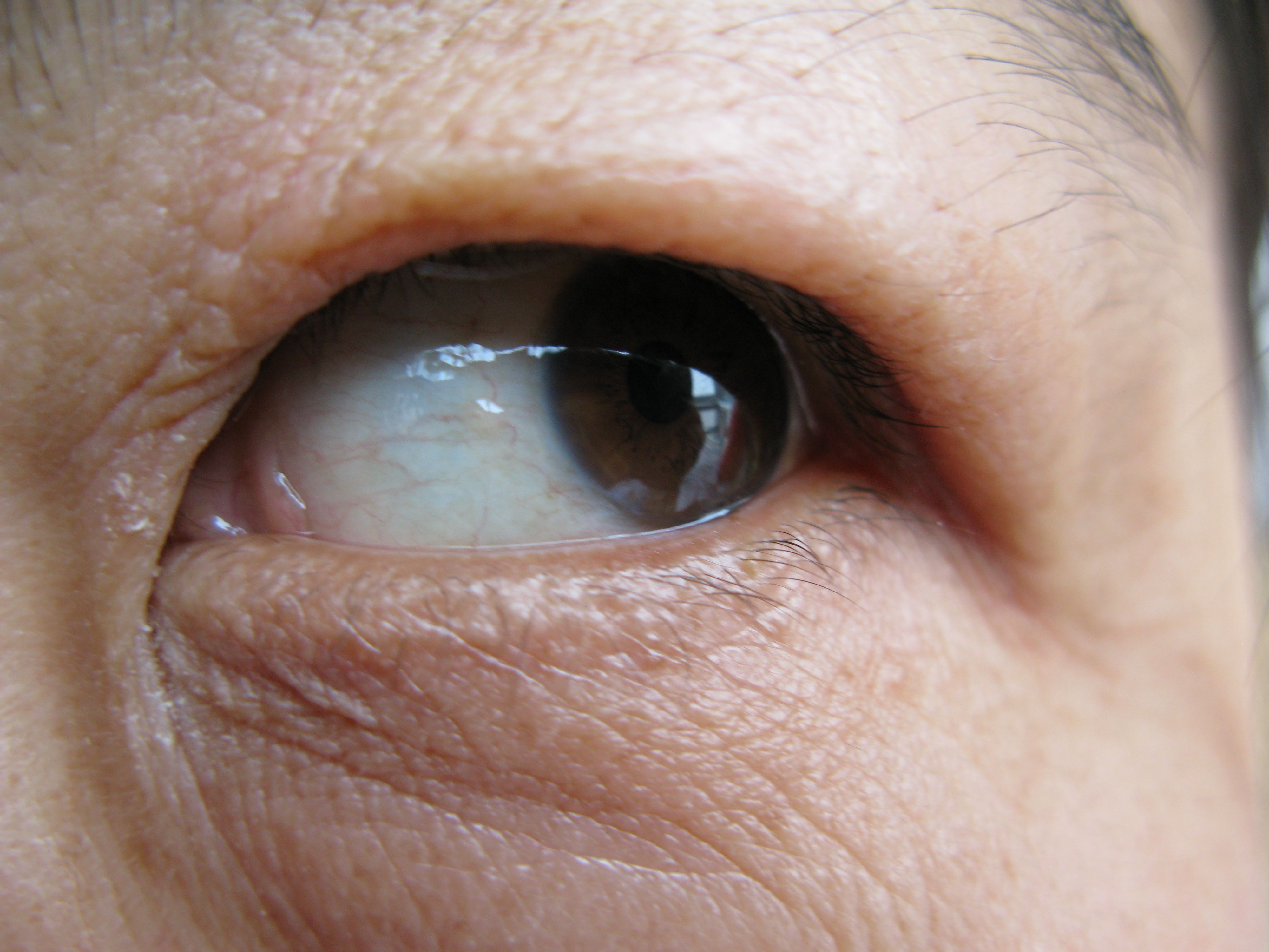 轻微白内障症状