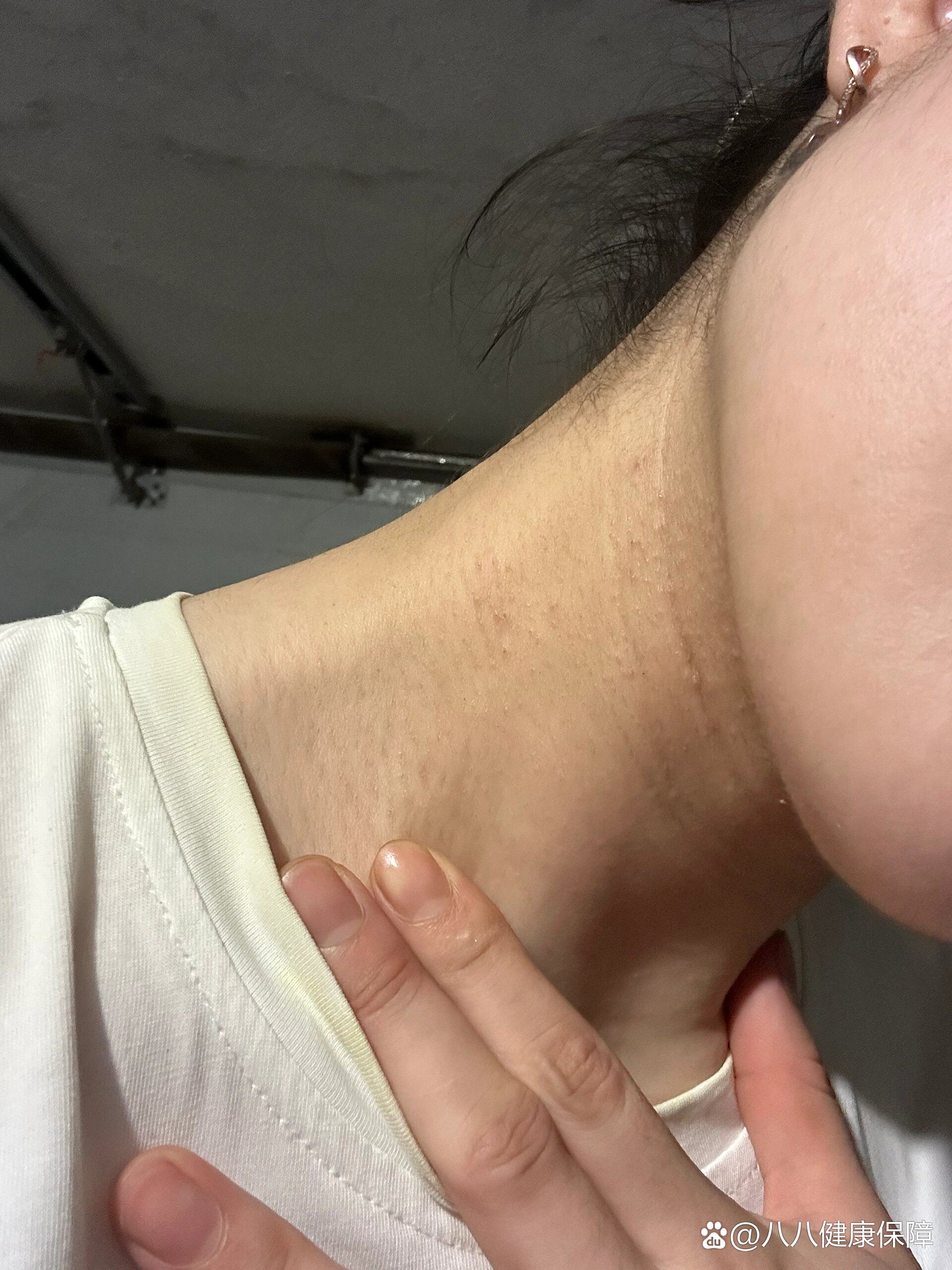 脖子长痘痘该怎么办