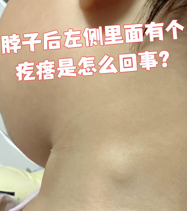 脖子长痘痘该怎么办