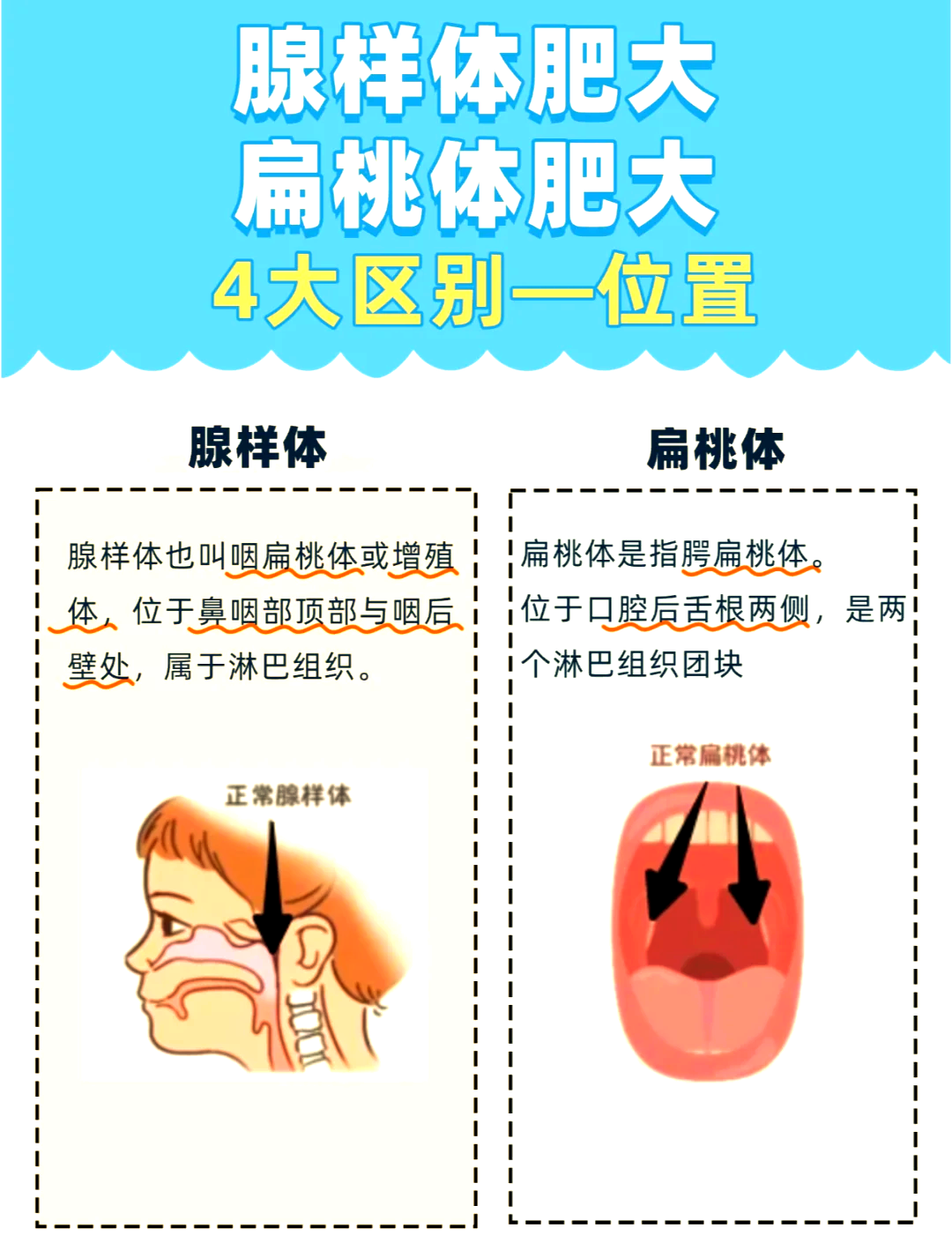 儿童扁桃体肥大怎么办