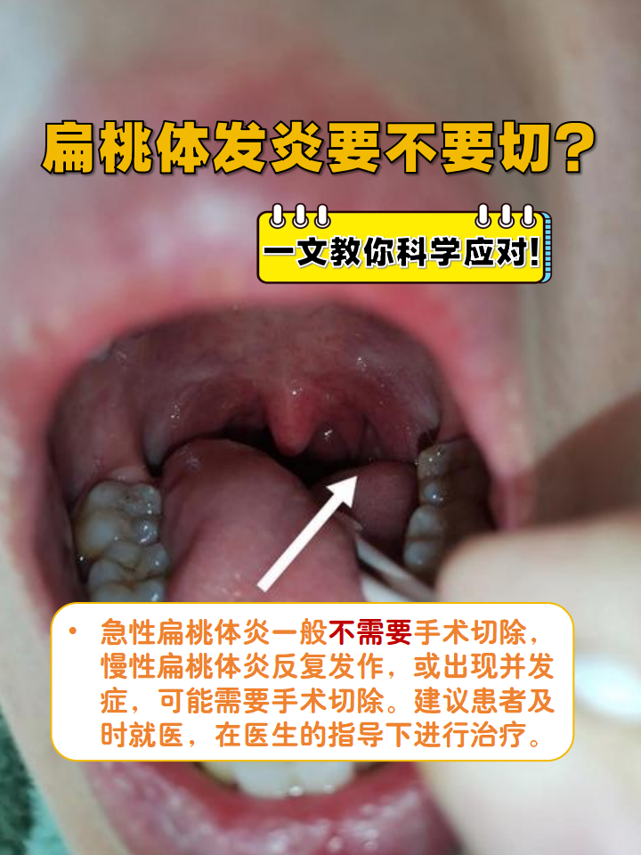 儿童扁桃体肥大怎么办